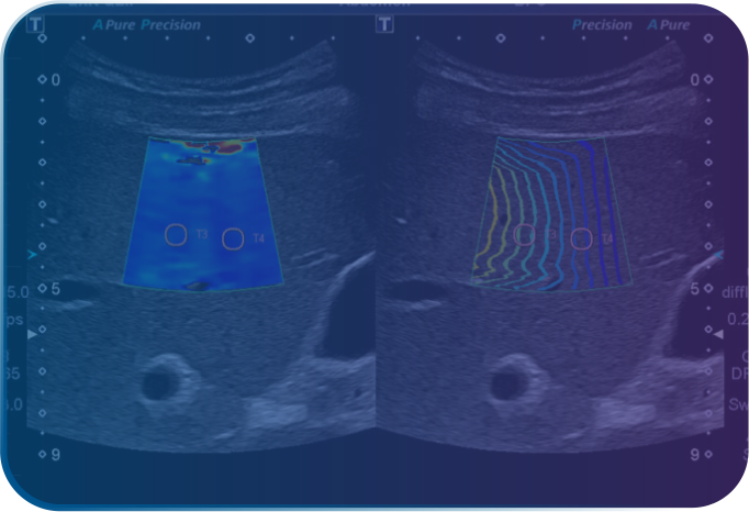 Elastography